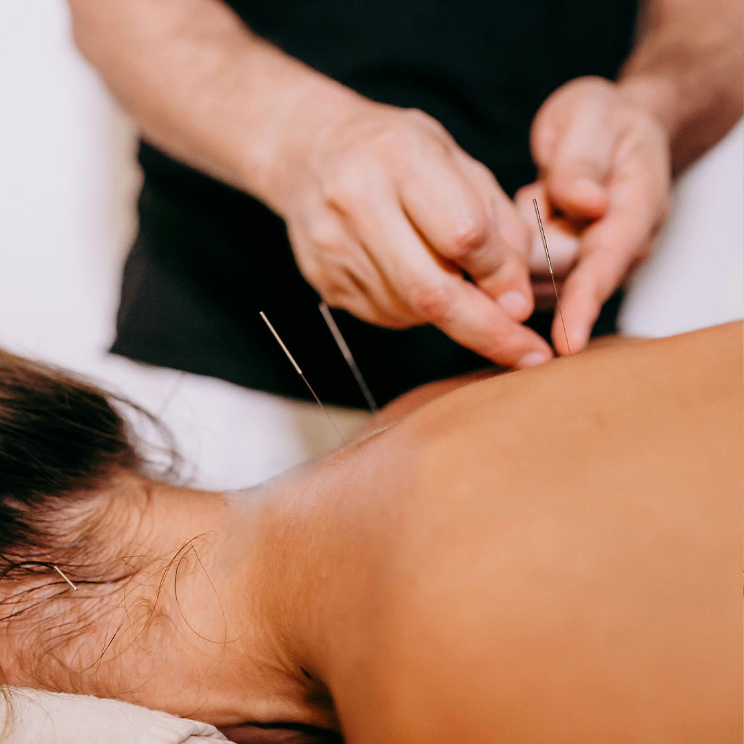 Dry Needling Therapy