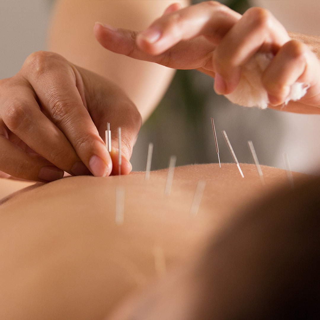 Dry Needling Therapy