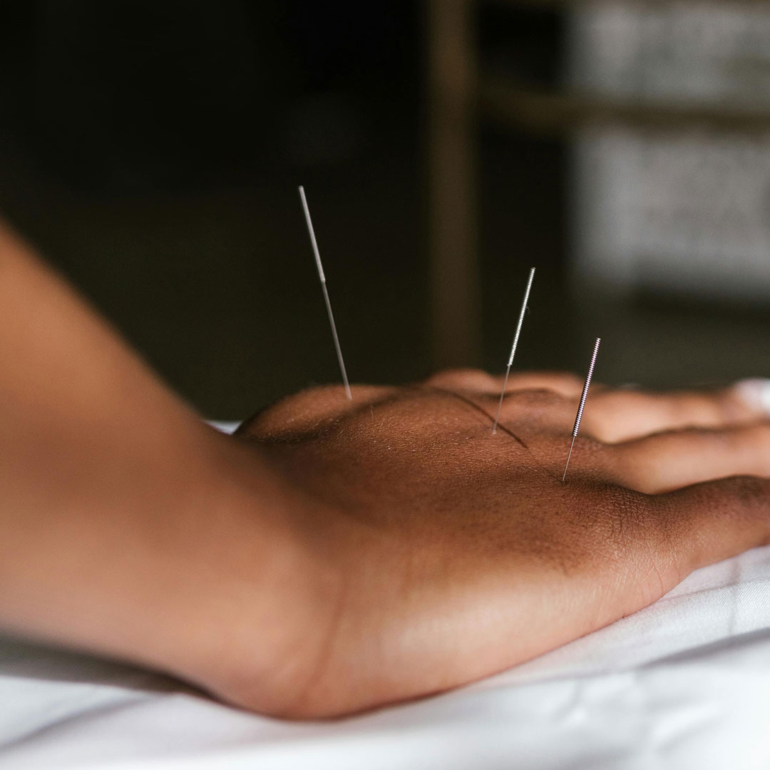 Dry Needling Therapy Dry Needling Therapy
