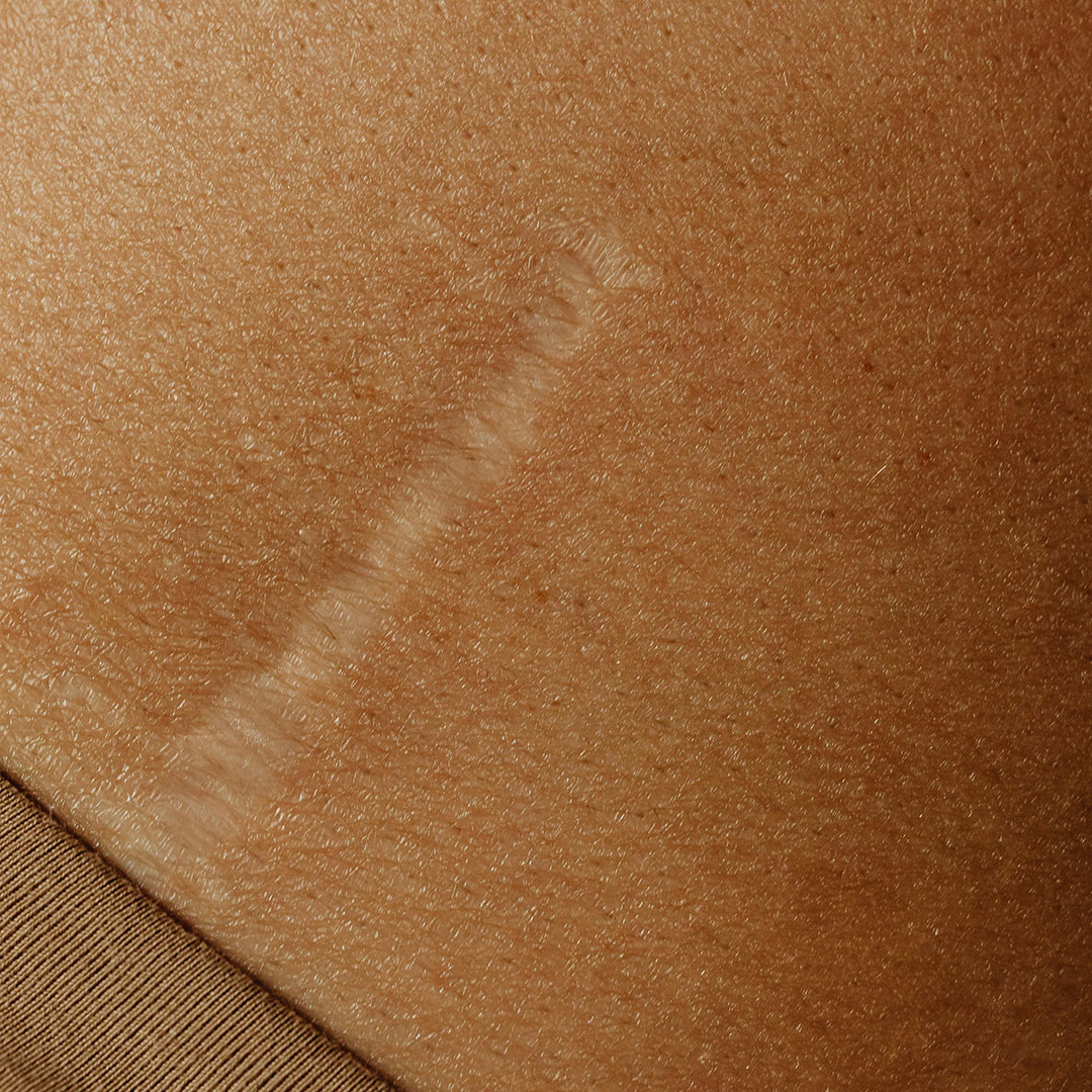 Scar Tissue Mobilization