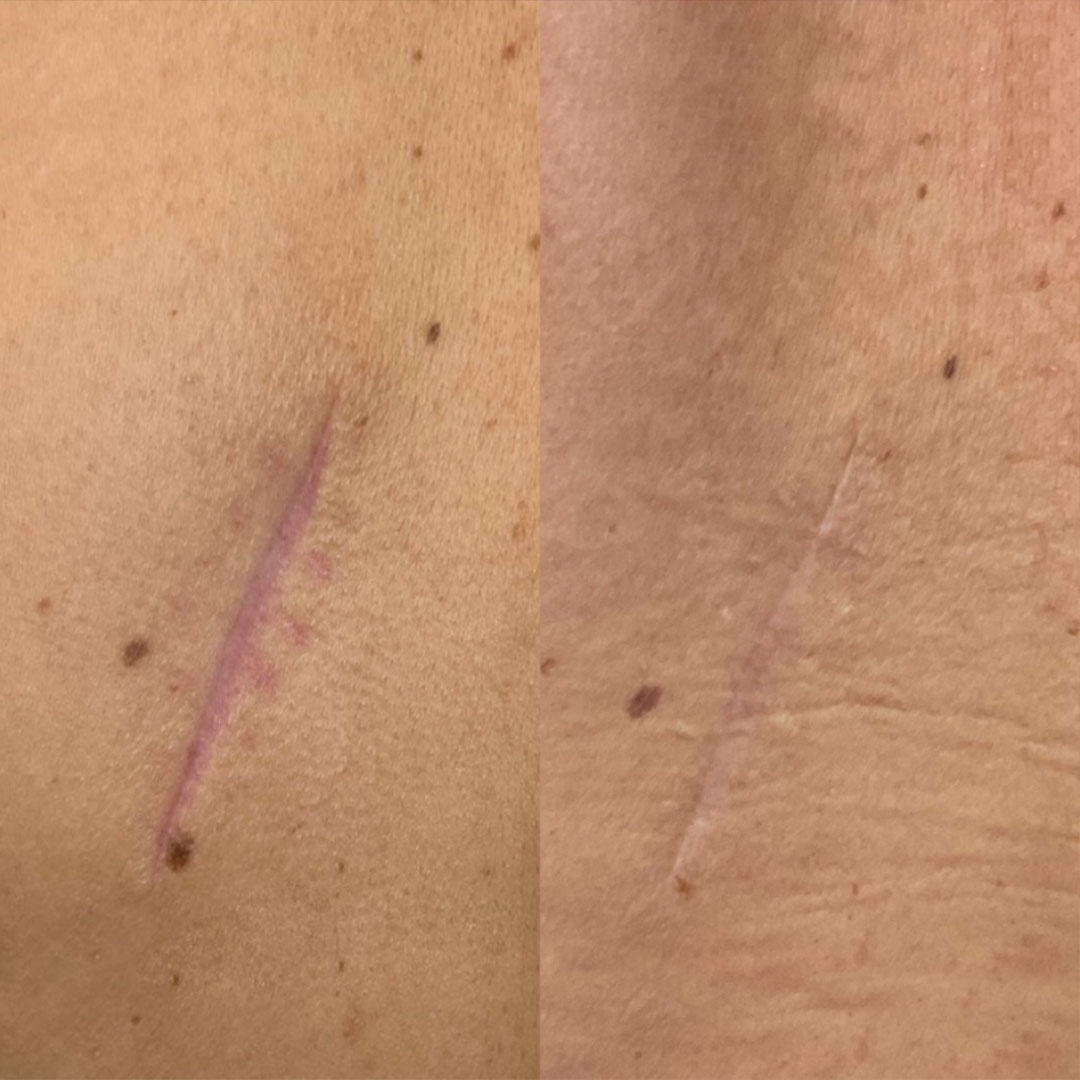 Scar Tissue Mobilization