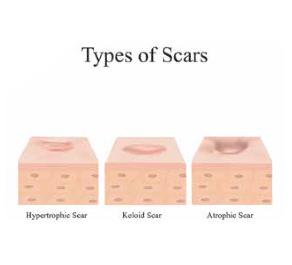 Scar Tissue Healing