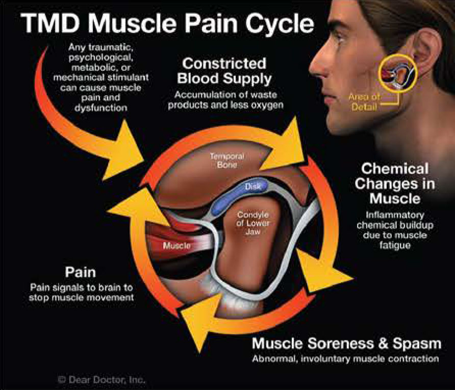 Temporomandibular Joint Dysfunction and Physical Therapy